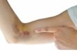 Синяк на руке – обычная вещь или опасная гематома